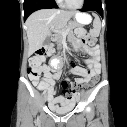 Castleman disease with fibrous pseudotumor in the abdomen (Radiopaedia 77296-89373 B 37).jpg