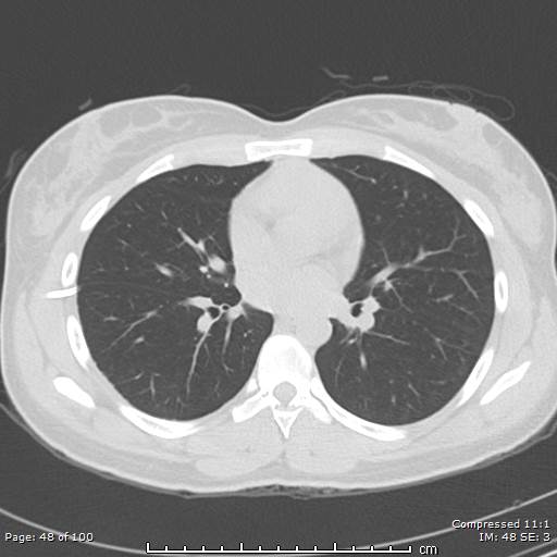 Catamenial pneumothorax (Radiopaedia 54382-60600 Axial non-contrast 48).jpg