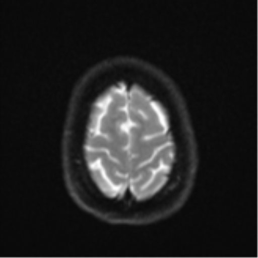 File:Cavernoma with bleed - midbrain (Radiopaedia 54546-60774 Axial DWI 24).png
