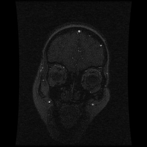 Cavernoma with developmental venous anomaly (Radiopaedia 22470-22507 MRV 106).jpg