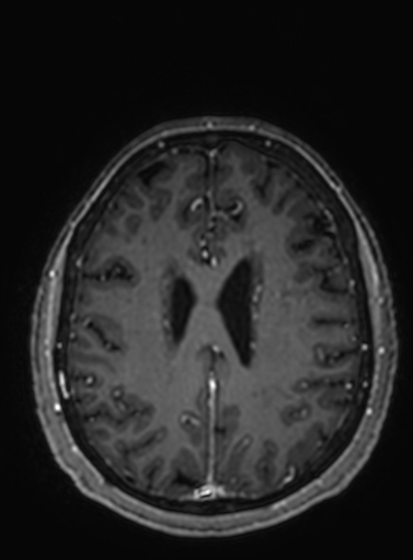 File:Cavernous hemangioma of the cerebellar falx (Radiopaedia 73025-83724 Axial T1 C+ 112).jpg