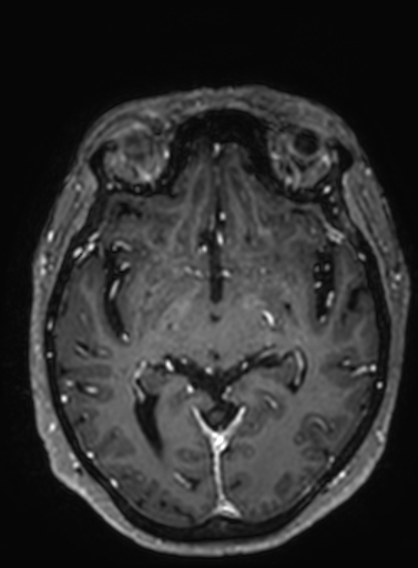 Cavernous hemangioma of the cerebellar falx (Radiopaedia 73025-83724 Axial T1 C+ 188).jpg