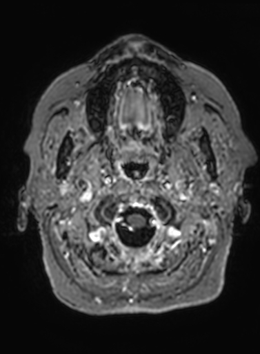 File:Cavernous hemangioma of the cerebellar falx (Radiopaedia 73025-83724 Axial T1 C+ 327).jpg