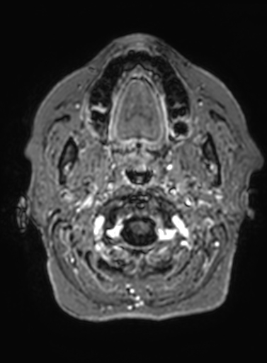 File:Cavernous hemangioma of the cerebellar falx (Radiopaedia 73025-83724 Axial T1 C+ 335).jpg