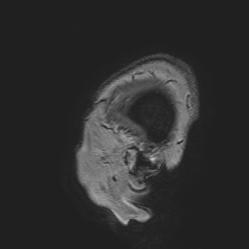 File:Cavernous hemangioma of the cerebellar falx (Radiopaedia 73025-83724 Sagittal T1 8).jpg