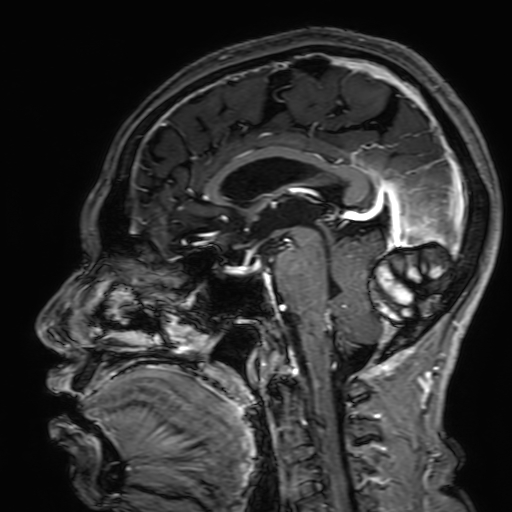 Cavernous hemangioma of the cerebellar falx (Radiopaedia 73025-83724 Sagittal T1 C+ 105).jpg