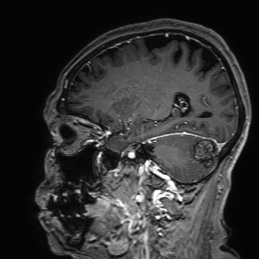 Cavernous hemangioma of the cerebellar falx (Radiopaedia 73025-83724 Sagittal T1 C+ 140).jpg