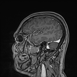 Cavernous sinus meningioma (Radiopaedia 63682-72367 Sagittal T1 C+ 51).jpg