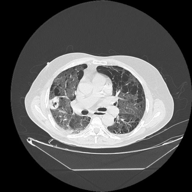 Cavitating bronchogenic carcinoma (Radiopaedia 44489-48162 Axial lung window 38).jpg