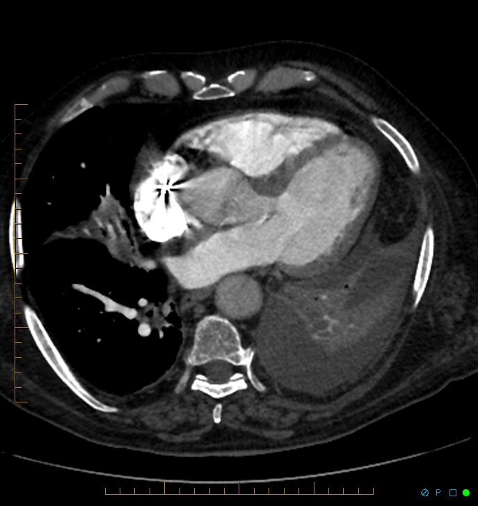 Cavitating pulmonary infarction (Radiopaedia 54634-60849 Axial C+ CTPA 53).jpg
