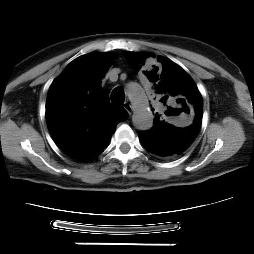 Cavitating pulmonary metastases (Radiopaedia 89545-106544 Axial non-contrast 16).jpg