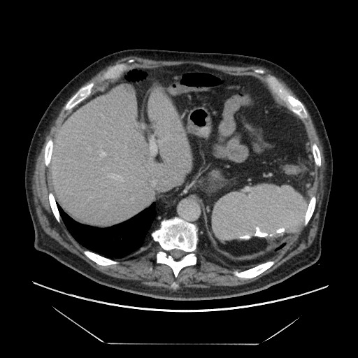 Cecal adenocarcinoma (Radiopaedia 64871-73817 A 15).jpg