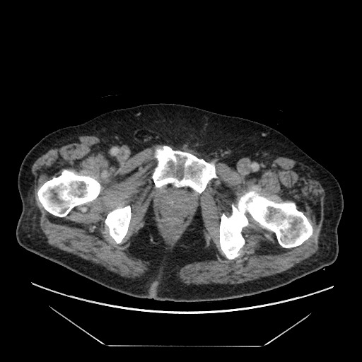 Cecal adenocarcinoma (Radiopaedia 64871-73817 A 97).jpg