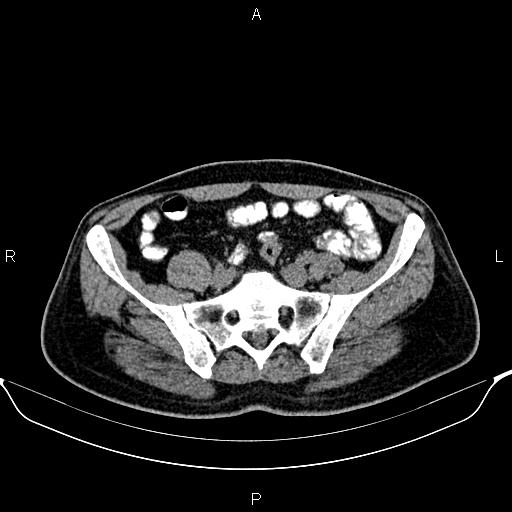 File:Cecal adenocarcinoma (Radiopaedia 85324-100916 Axial non-contrast 72).jpg