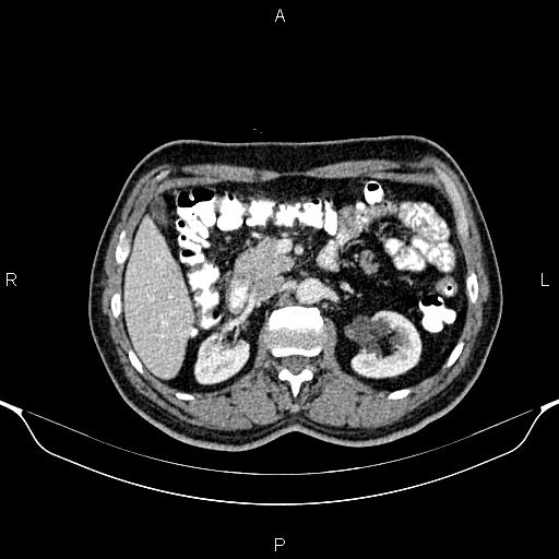 Cecal adenocarcinoma (Radiopaedia 85324-100916 B 35).jpg