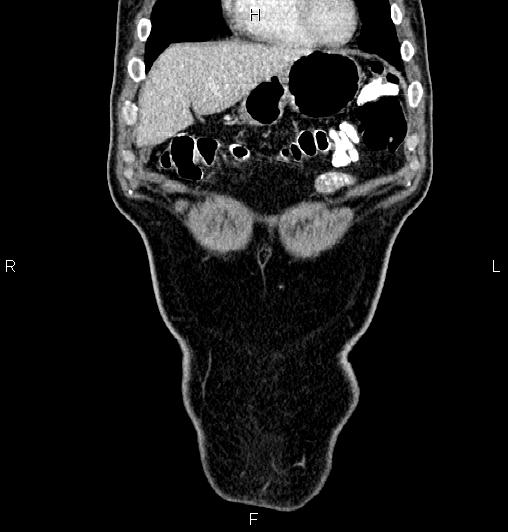 File:Cecal adenocarcinoma (Radiopaedia 85324-100916 D 9).jpg