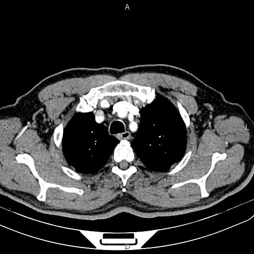 File:Cecal cancer with appendiceal mucocele (Radiopaedia 91080-108651 A 16).jpg