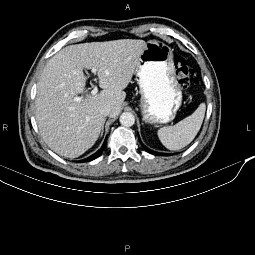File:Cecal cancer with appendiceal mucocele (Radiopaedia 91080-108651 B 24).jpg