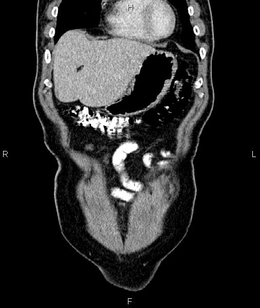 File:Cecal cancer with appendiceal mucocele (Radiopaedia 91080-108651 D 12).jpg