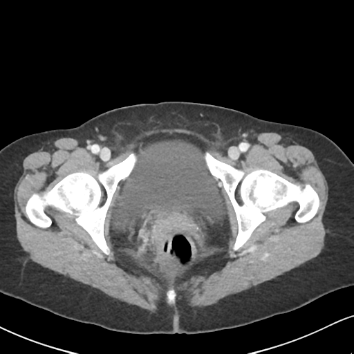 Cecal internal hernia through the foramen of Winslow (Radiopaedia 44820-48651 B 75).png