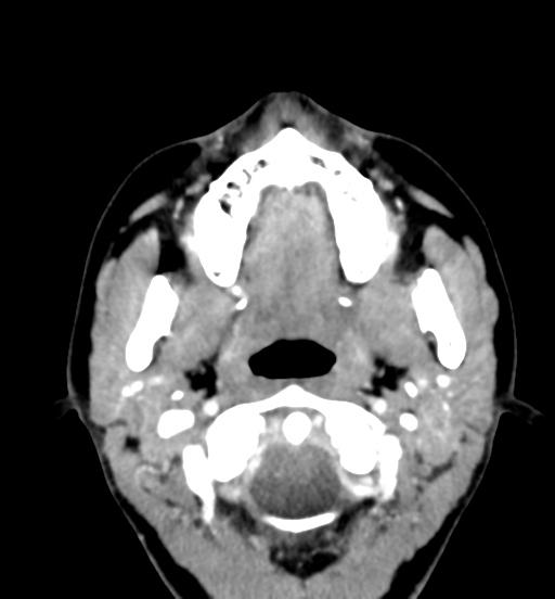 File:Cemento-ossifying fibroma (Radiopaedia 46243-50643 Axial C+ delayed 31).png