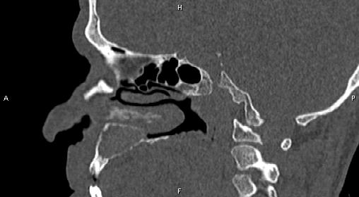 File:Central giant cell granuloma (Radiopaedia 83346-97761 Sagittal bone window 21).jpg