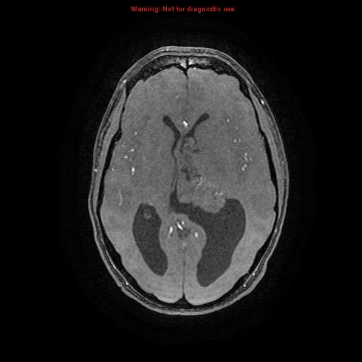 File:Central neurocytoma (Radiopaedia 13188-13206 Axial MRA 49).jpg