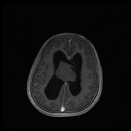 Central neurocytoma (Radiopaedia 30220-30842 Axial T1 C+ 100).jpg