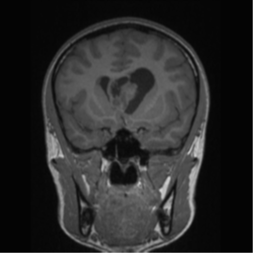 Central neurocytoma (Radiopaedia 37664-39557 Coronal T1 58).png