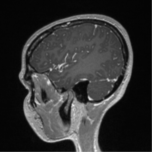 Central neurocytoma (Radiopaedia 37664-39557 Sagittal T1 C+ 22).png