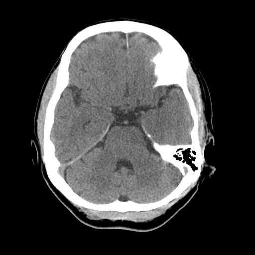Central neurocytoma (Radiopaedia 68725-78432 Axial non-contrast 15).jpg
