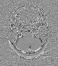 File:Central neurocytoma (Radiopaedia 84497-99872 Axial 10).jpg