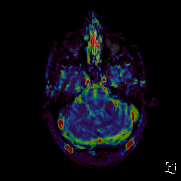 Central neurocytoma (Radiopaedia 84497-99872 Axial Perfusion 242).jpg