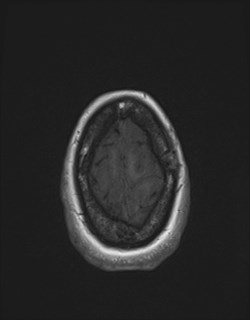 Central neurocytoma (Radiopaedia 84497-99872 Axial T1 171).jpg