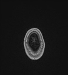 Central neurocytoma (Radiopaedia 84497-99872 Axial T1 C+ 149).jpg