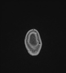 Central neurocytoma (Radiopaedia 84497-99872 Axial T1 C+ 152).jpg