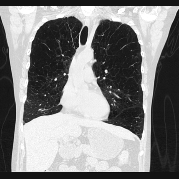 Centrilobular pulmonary emphysema (Radiopaedia 24495-24789 Coronal lung window 29).jpg