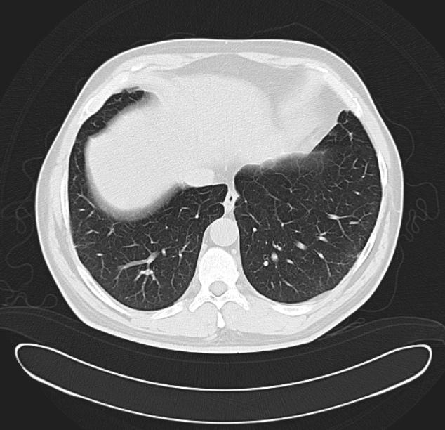 Centrilobular pulmonary emphysema (Radiopaedia 26808-26971 C 35).jpg