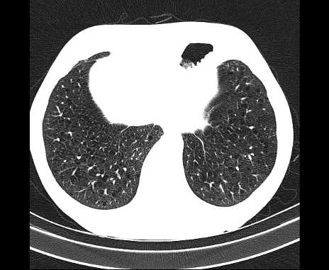 Centrilobular pulmonary emphysema (Radiopaedia 62468-70718 Axial lung window 65).jpg