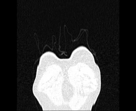 Centrilobular pulmonary emphysema (Radiopaedia 62468-70718 Coronal lung window 1).jpg