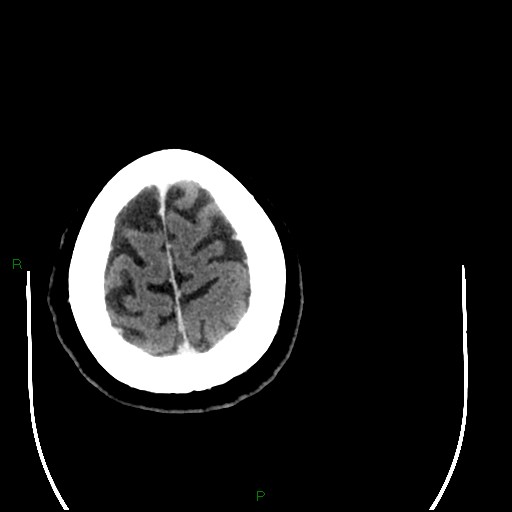 Cerebellar abscess (Radiopaedia 78135-90671 Axial C+ delayed 99).jpg
