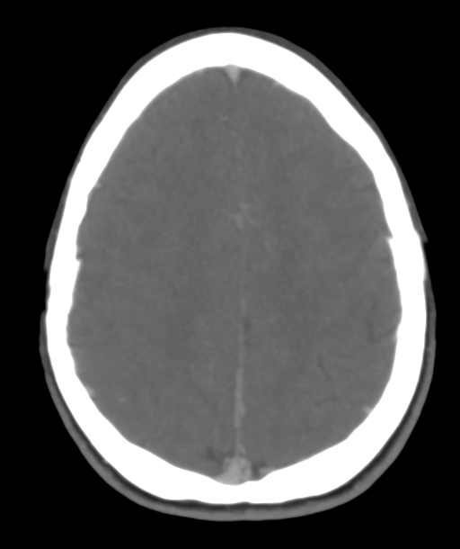 Cerebellar arteriovenous malformation- with hemorrhage (Radiopaedia 35752-37297 B 39).png