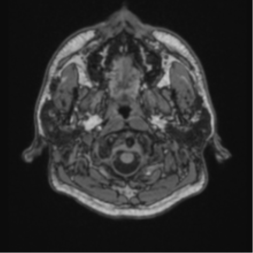 Cerebellar hemangioblastomas and pituitary adenoma (Radiopaedia 85490-101176 Axial T1 3).png