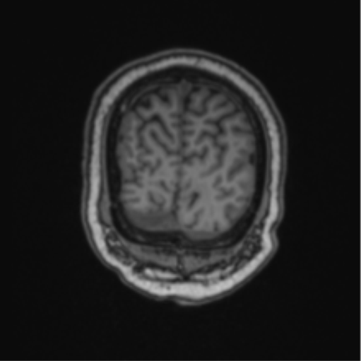 Cerebellar hemangioblastomas and pituitary adenoma (Radiopaedia 85490-101176 Coronal T1 17).png
