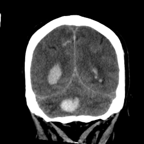 Cerebellar hemorrhage causing obstructive hydrocephalus (Radiopaedia 33989-35207 Coronal non-contrast 41).jpg