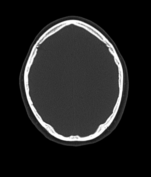 File:Cerebellar metastases - colorectal adenocarcinoma (Radiopaedia 40947-43652 AX Bone C- 2.0 MPR 47).png