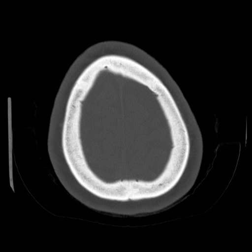 Cerebellar metastasis (cystic appearance) (Radiopaedia 41395-44258 Axial bone window 63).png