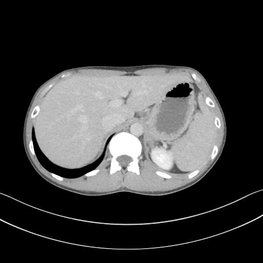 Cerebellar metastasis - adenocarcinoma lung (Radiopaedia 63184-71717 Axial C+ delayed 66).png