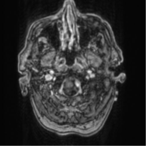 File:Cerebellar metastasis from lung adenocarcinoma (Radiopaedia 86690-102829 Axial T1 C+ 10).png