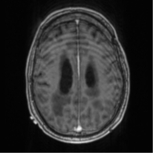 Cerebellar metastasis from lung adenocarcinoma (Radiopaedia 86690-102829 Axial T1 C+ 56).png